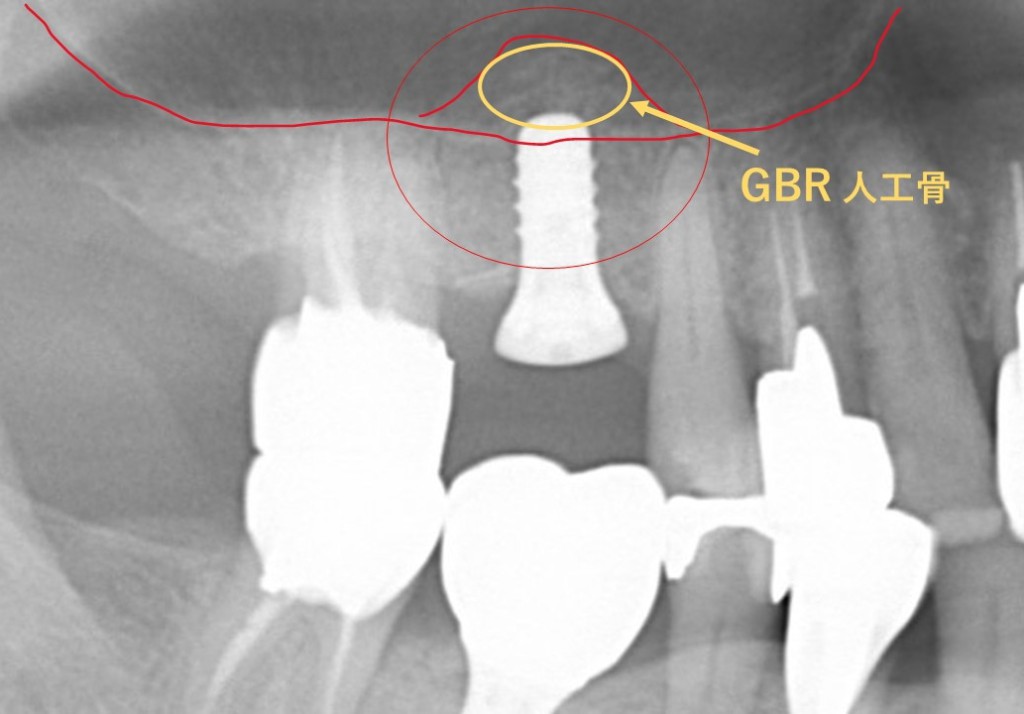 【症例】ソケットリフト（オステオトームテクニック）によるインプラント治療｜治療後人工骨にインプラントを埋入したレントゲン画像｜京橋 銀座みらい歯科症例