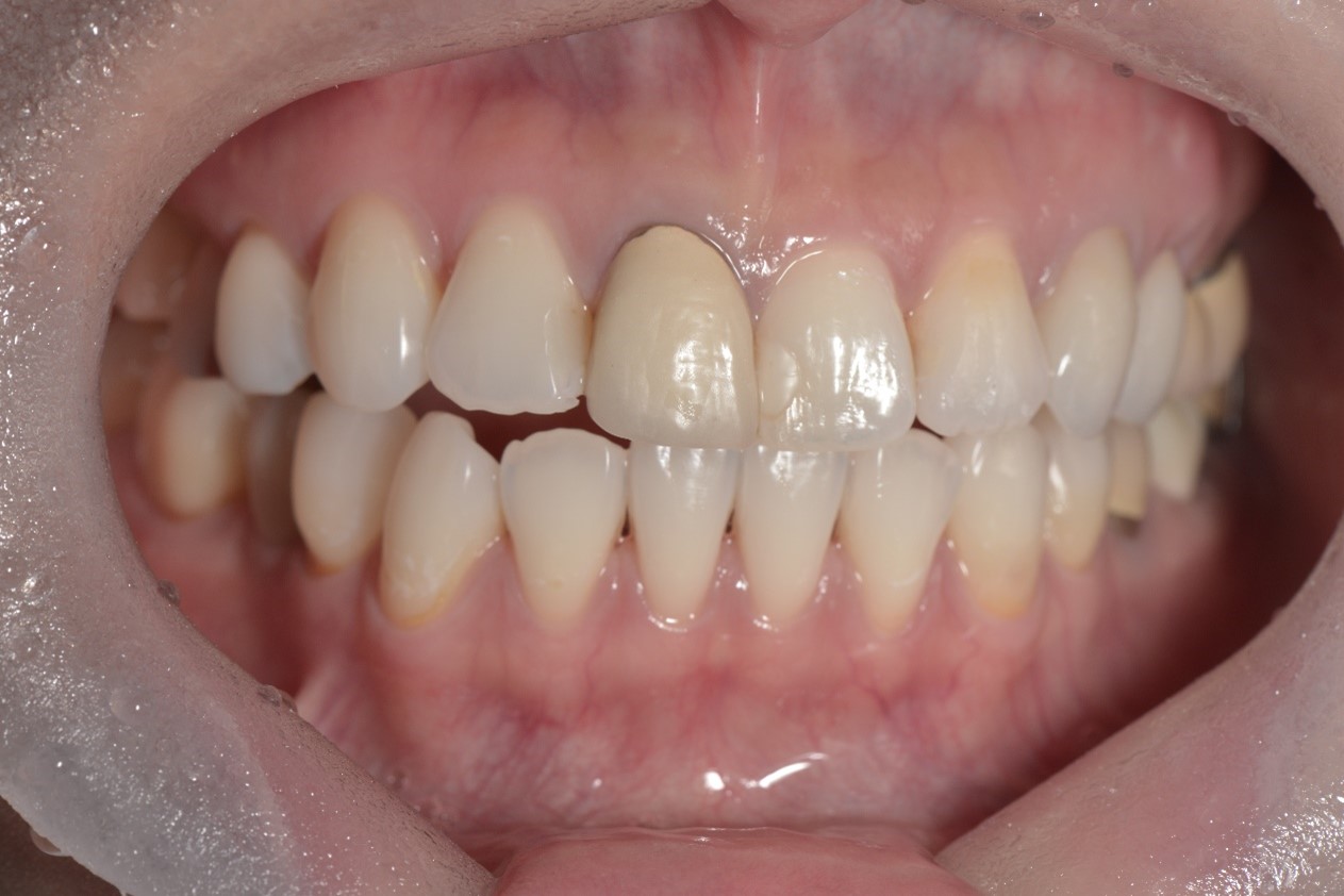 【症例】前歯の審美治療 ジルコニアセラミックでの修復