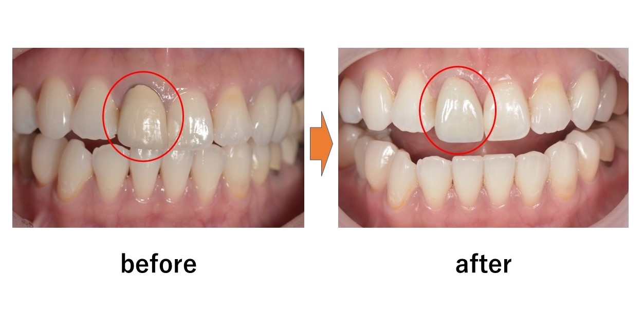 【症例】前歯の審美治療 ジルコニアセラミックでの修復