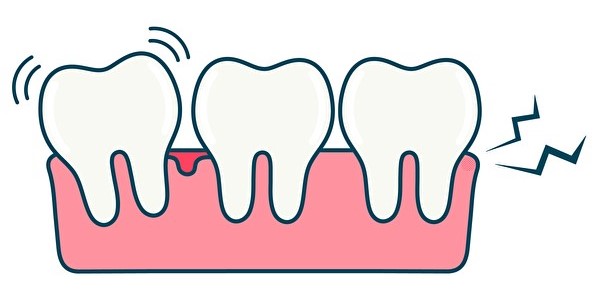 【ブログ】歯周病が誘発する全身疾患と、妊娠との関係性について解説｜京橋・銀座の歯医者｜京橋 銀座みらい歯科の症例 ｜歯周病の画像