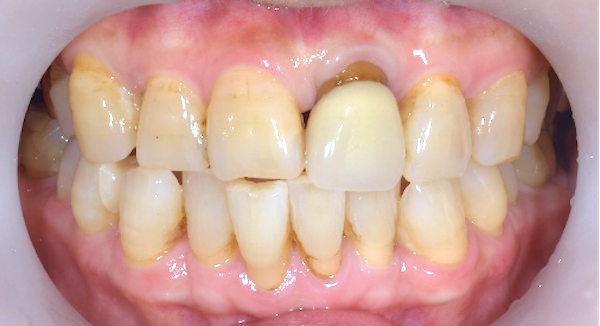 京橋 銀座みらい歯科｜症例｜【症例】ジルコニアセラミックによる前歯の治療｜治療前の歯の画像