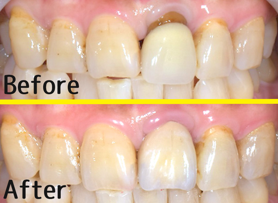 【症例】ジルコニアセラミックによる前歯の治療