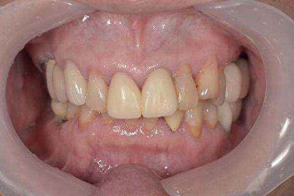 【症例】前歯の被せものの劣化をジルコニアセラミック治療で修復｜京橋 銀座みらい歯科｜仮歯の写真