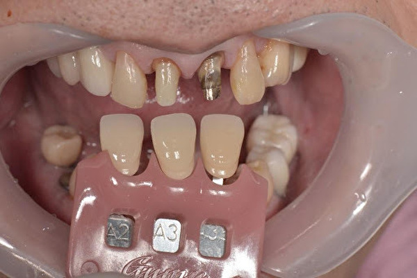 【症例】前歯の被せものの劣化をジルコニアセラミック治療で修復｜京橋 銀座みらい歯科｜型取りの写真