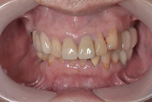 【症例】前歯の被せものの劣化をジルコニアセラミック治療で修復｜京橋 銀座みらい歯科｜治療後の写真