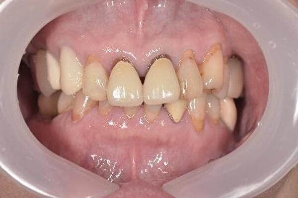 【症例】前歯の被せものの劣化をジルコニアセラミック治療で修復｜京橋 銀座みらい歯科｜治療前の写真