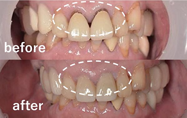 【症例】前歯の被せものの劣化をジルコニアセラミック治療で修復