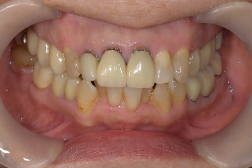 【症例】歯と被せ物の間に隙間ができ変色した前歯に対するセラミック治療｜京橋 銀座みらい歯科｜治療前