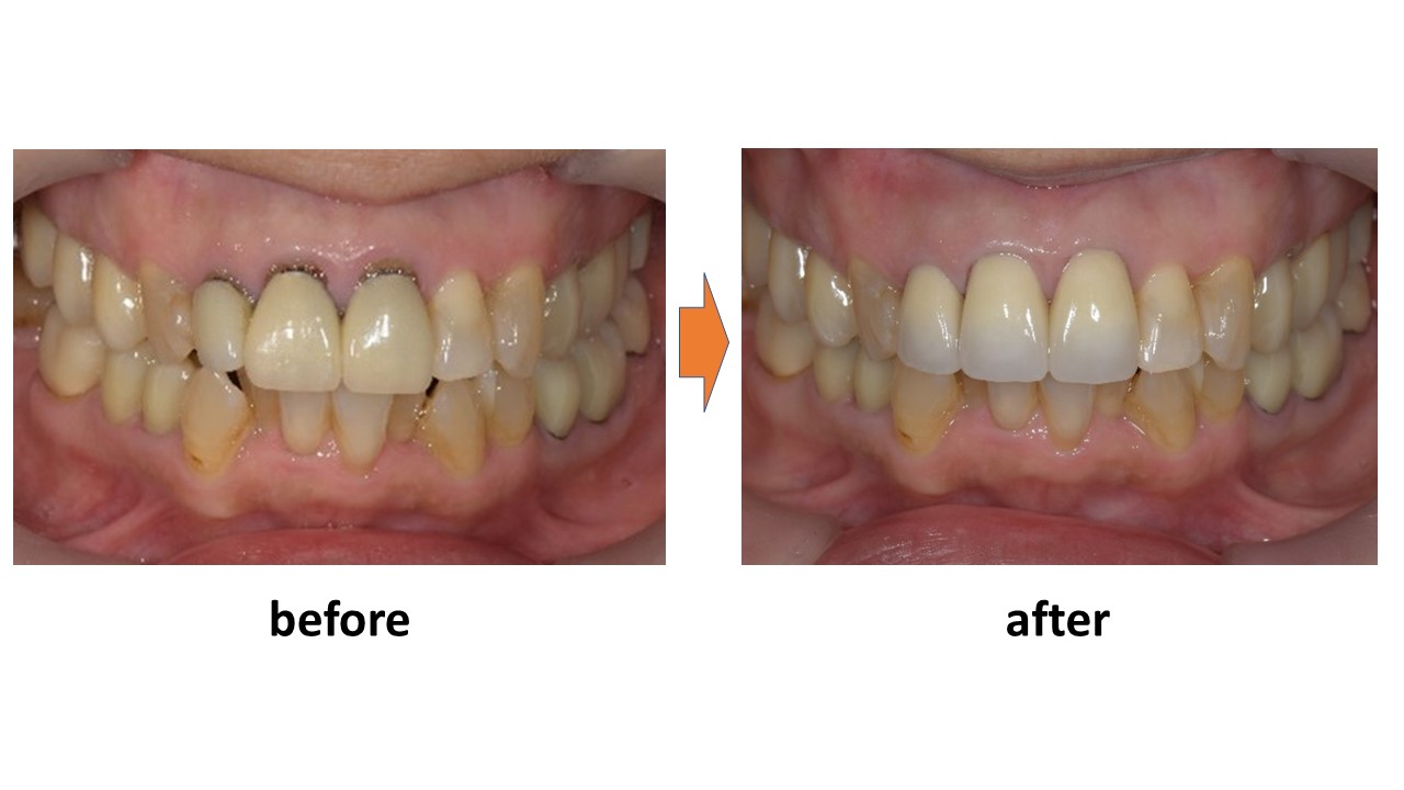 【症例】歯と被せ物の間に隙間ができ変色した前歯に対するセラミック治療
