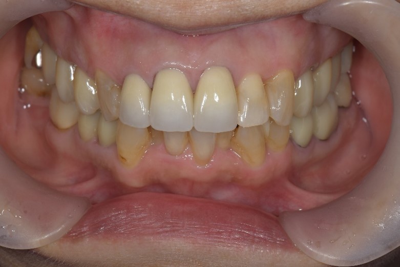 【症例】歯と被せ物の間に隙間ができ変色した前歯に対するセラミック治療｜京橋 銀座みらい歯科｜治療後