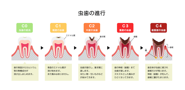 京橋 銀座みらい歯科｜ブログ｜なぜ虫歯ができるの？歯磨きだけではないセルフケア｜虫歯の進行図解イラスト