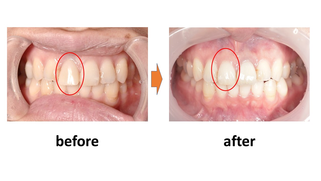 【症例】仮歯のまま放置していた前歯のジルコニアセラミックによる修復