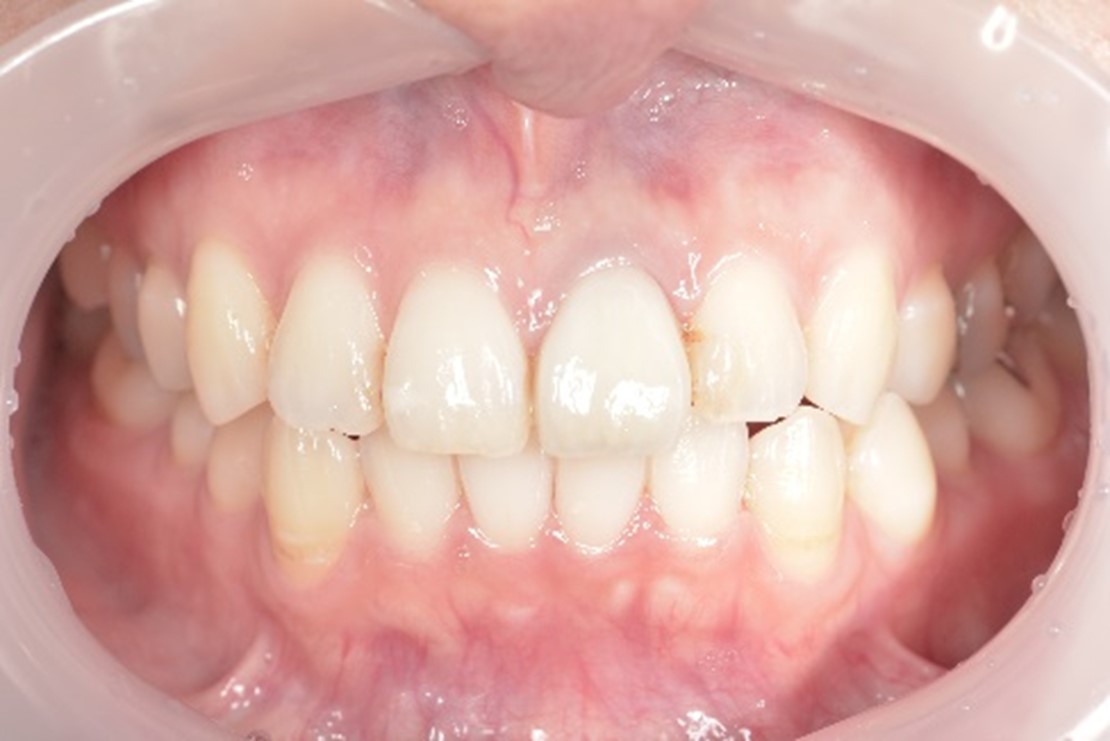 【症例】仮歯のまま放置していた前歯のジルコニアセラミックによる修復