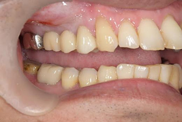 【症例】劣化した15年前の被せ物をジルコニアの被せ物へ｜京橋 銀座みらい歯科｜治療中の画像