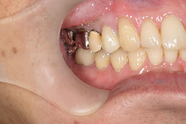 【症例】劣化した15年前の被せ物をジルコニアの被せ物へ｜京橋 銀座みらい歯科｜治療前の画像