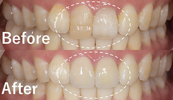 【症例】過去に外傷で折れた歯の再修復で前歯の見た目を改善
