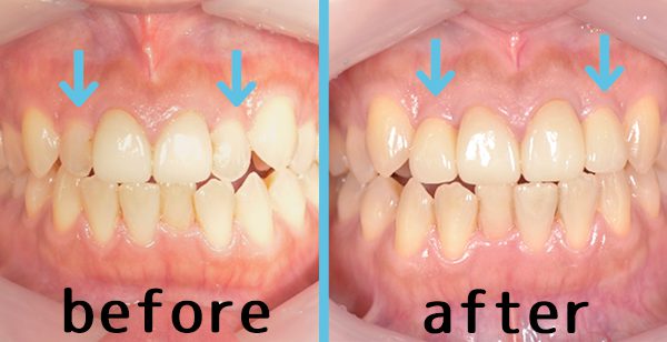 【症例】前歯をジルコニアセラミックで修復した審美治療