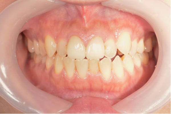 【症例】前歯をジルコニアセラミックで修復した審美治療｜治療前の画像｜京橋 銀座みらい歯科