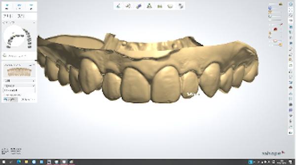 【症例】前歯をジルコニアセラミックで修復した審美治療｜歯の模型の解析画像｜京橋 銀座みらい歯科