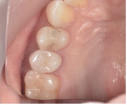 【症例】奥歯のジルコニアセラミック治療｜京橋 銀座みらい歯科｜治療前後画像2
