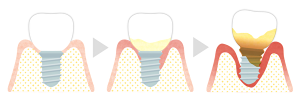 銀座みらい歯科｜歯科衛生士ブログ｜インプラント周囲炎とは？｜インプラント周囲炎の症状