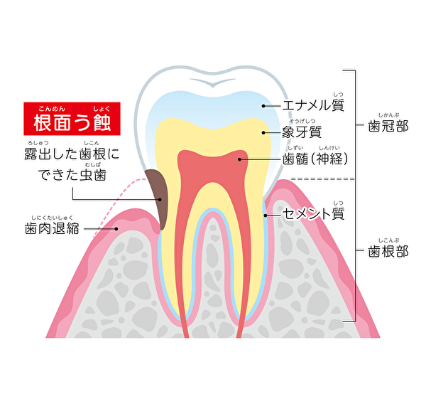 銀座みらい歯科｜歯科衛生士ブログ｜虫歯の原因とそのリスクについて｜根面虫歯における酸蝕症のリスク