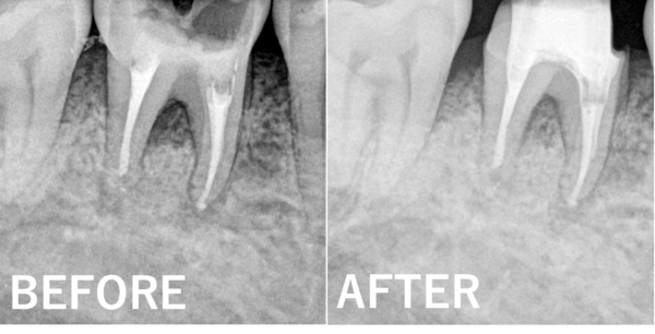 【症例】歯茎から膿が出てきて不安。溶けてしまった骨に対する歯周再生療法