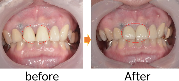 【症例】神経を取る治療の後仮歯のまま放置していた前歯をジルコニアセラミックで修復