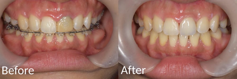 【症例】矯正治療後に前歯の仮歯をジルコニアセラミックへ