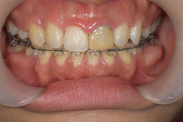 銀座みらい歯科｜【症例】矯正治療後に前歯の仮歯をジルコニアセラミックへ｜治療前画像