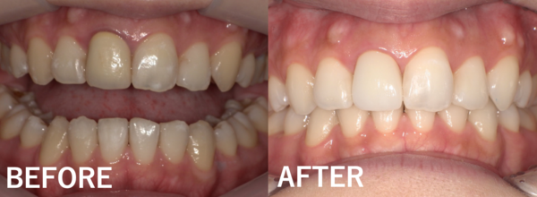 【症例】昔治療した前歯の被せ物をジルコニアセラミックスでやり替え治療