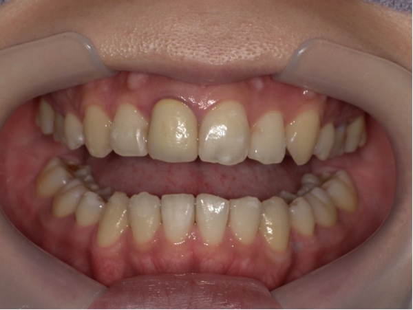 治療前｜【症例】昔治療した前歯の被せ物をジルコニアセラミックスでやり替え治療｜京橋駅直結の歯医者 京橋 銀座みらい歯科