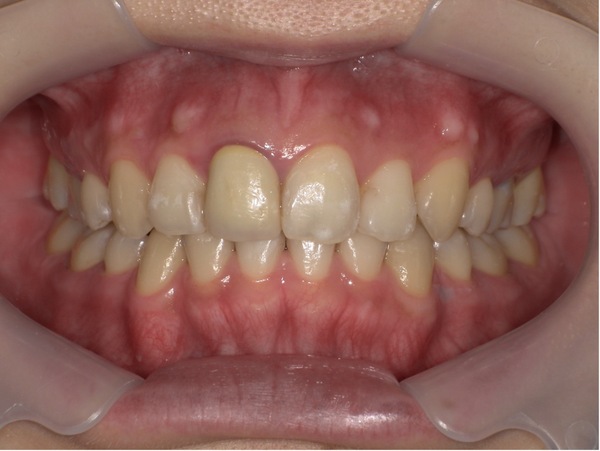 仮歯装着時｜【症例】昔治療した前歯の被せ物をジルコニアセラミックスでやり替え治療｜京橋駅直結の歯医者 京橋 銀座みらい歯科