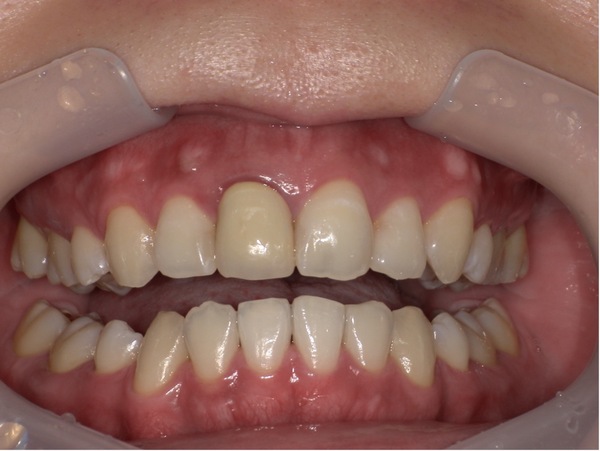 ホワイトニング後｜【症例】昔治療した前歯の被せ物をジルコニアセラミックスでやり替え治療｜京橋駅直結の歯医者 京橋 銀座みらい歯科