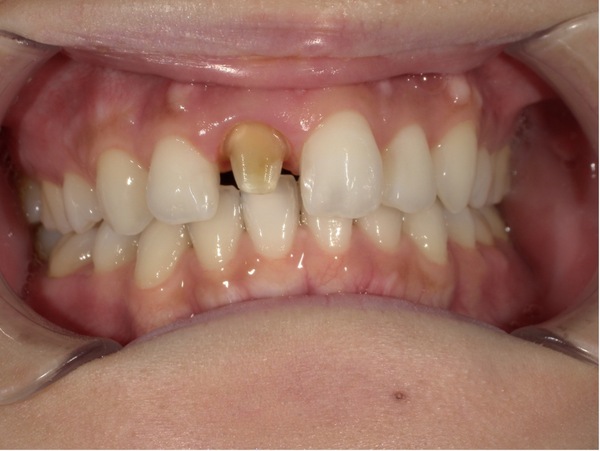 型取り時｜【症例】昔治療した前歯の被せ物をジルコニアセラミックスでやり替え治療｜京橋駅直結の歯医者 京橋 銀座みらい歯科