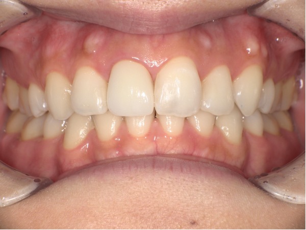 治療後｜【症例】昔治療した前歯の被せ物をジルコニアセラミックスでやり替え治療｜京橋駅直結の歯医者 京橋 銀座みらい歯科