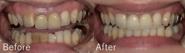 【症例】気になる歯の並びをジルコニアセラミックで修復