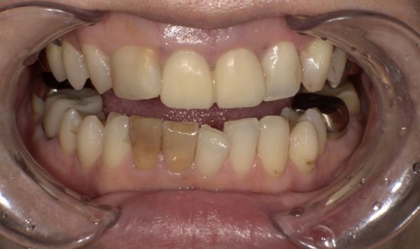 治療詳細画像1｜【症例】気になる歯の並びをジルコニアセラミックで修復｜京橋駅直結の歯医者 京橋 銀座みらい歯科