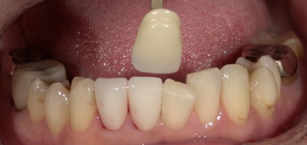 治療詳細画像2｜【症例】気になる歯の並びをジルコニアセラミックで修復｜京橋駅直結の歯医者 京橋 銀座みらい歯科