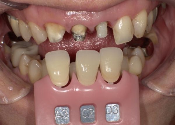 治療詳細画像3｜【症例】気になる歯の並びをジルコニアセラミックで修復｜京橋駅直結の歯医者 京橋 銀座みらい歯科