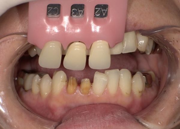 治療詳細画像4｜【症例】気になる歯の並びをジルコニアセラミックで修復｜京橋駅直結の歯医者 京橋 銀座みらい歯科