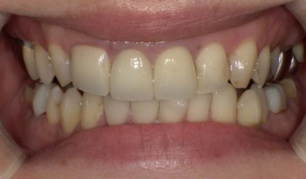 治療後画像1｜【症例】気になる歯の並びをジルコニアセラミックで修復｜京橋駅直結の歯医者 京橋 銀座みらい歯科