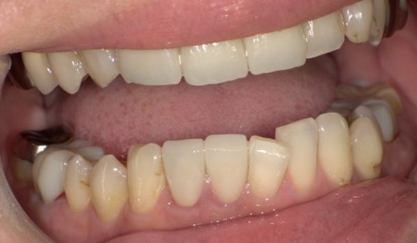 治療後画像2｜【症例】気になる歯の並びをジルコニアセラミックで修復｜京橋駅直結の歯医者 京橋 銀座みらい歯科