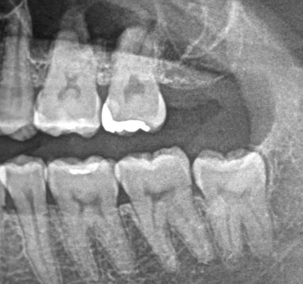 親知らずの画像②｜【症例】気になる歯の並びをジルコニアセラミックで修復｜京橋駅直結の歯医者 京橋 銀座みらい歯科