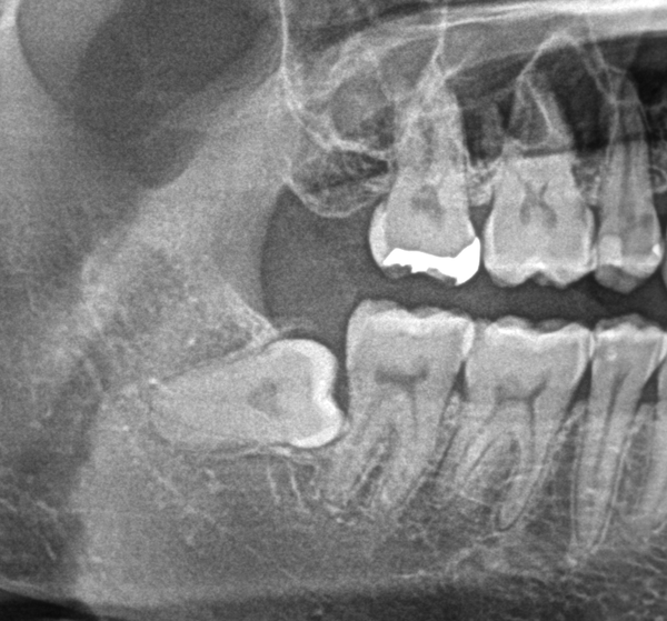 親知らずの画像①｜【症例】気になる歯の並びをジルコニアセラミックで修復｜京橋駅直結の歯医者 京橋 銀座みらい歯科