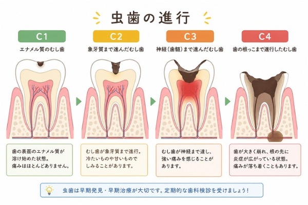 虫歯の進行画像 | 【症例】定期検診で発見された虫歯に対するセラミック治療