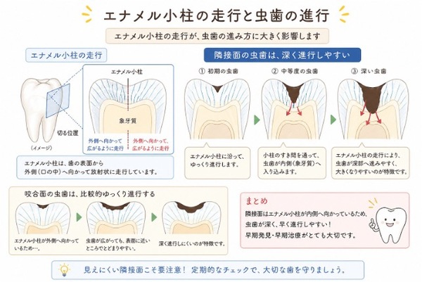 エナメル小柱画像 | 【症例】定期検診で発見された虫歯に対するセラミック治療