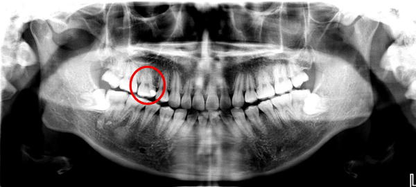 治療前レントゲン画像|【症例】コンポジットレジンの下の虫歯を除去しe-maxで治療 | 京橋駅直結の歯医者 京橋 銀座みらい歯科