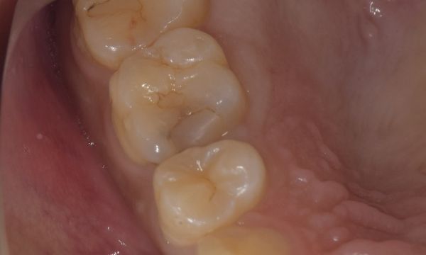 治療前画像|【症例】コンポジットレジンの下の虫歯を除去しe-maxで治療 | 京橋駅直結の歯医者 京橋 銀座みらい歯科