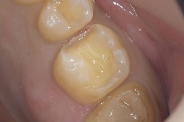 詰め物成形画像|【症例】欠けてしまった歯をジルコニアインレーで治療|京橋・銀座の歯医者 「京橋 銀座みらい歯科」